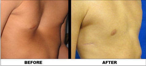 Pectus patient (16 years old) before surgery and after surgery photo.